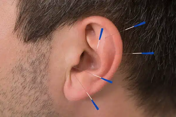 benefícios da acupuntura auricular