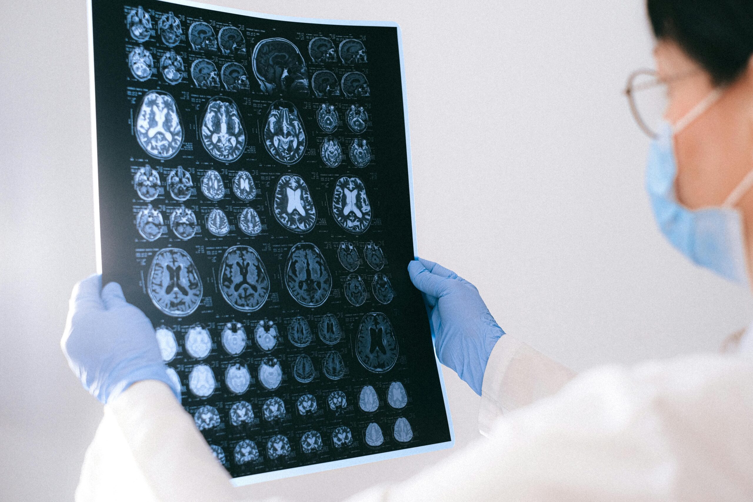IA Revela Fatores de Risco para Alzheimer!