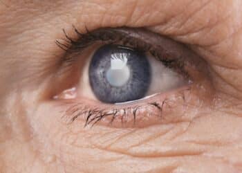 glaucoma