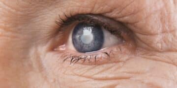 glaucoma