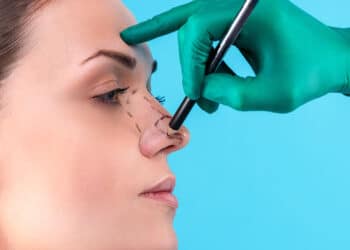 rinoplastia