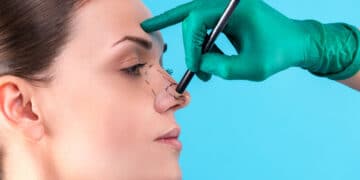 rinoplastia