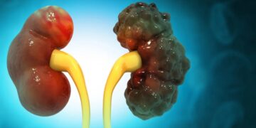 Ilustração mostra como pode ficar um rim policístico (Fonte: Reprodução/Getty Images)