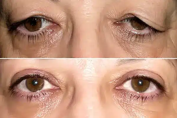 Confira um antes e despois de como levantar pálpebras caídas com a cirurgia de blefaroplastia! (Fonte: Dr. Diego Silveira)