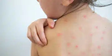 Brasil à beira de recuperar o status de nação livre de sarampo (Fonte: Veja Saúde)