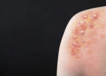 O recrudescimento da Mpox e a declaração de Emergência de Saúde Pública de Importância Internacional pela OMS