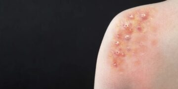 O recrudescimento da Mpox e a declaração de Emergência de Saúde Pública de Importância Internacional pela OMS
