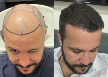 Transplante de Cabelo: A Solução para a Calvície que Está em Alta