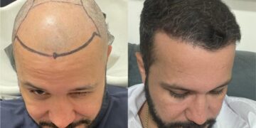 Transplante de Cabelo: A Solução para a Calvície que Está em Alta