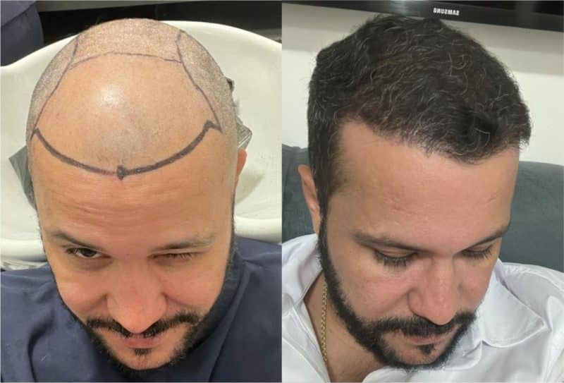 Transplante de Cabelo: A Solução para a Calvície que Está em Alta